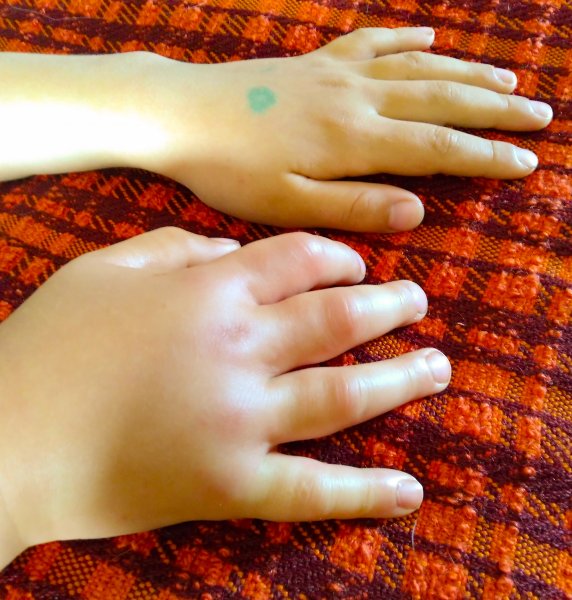 Co dělat, když vás bodne včela?